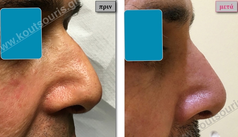 rhinoplasty-with-hyaluronic-acid-27