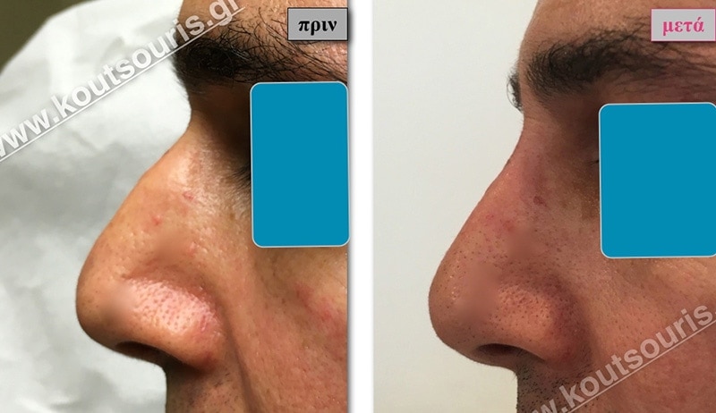 rhinoplasty-with-hyaluronic-acid-28