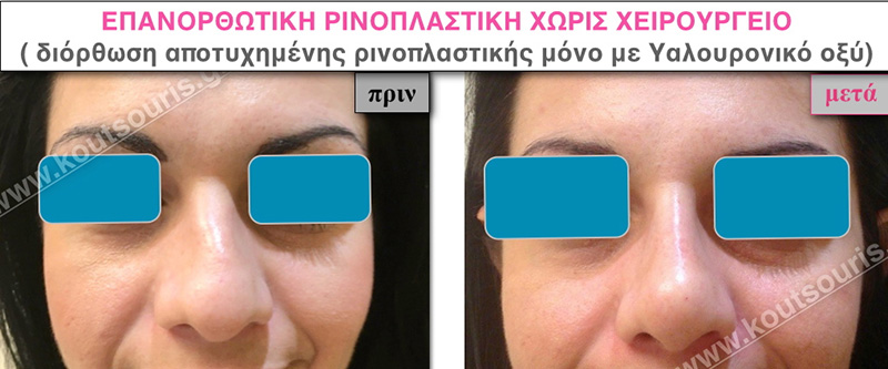 rhinoplasty-with-hyaluronic-acid-29