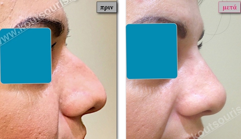 rhinoplasty-with-hyaluronic-acid-30