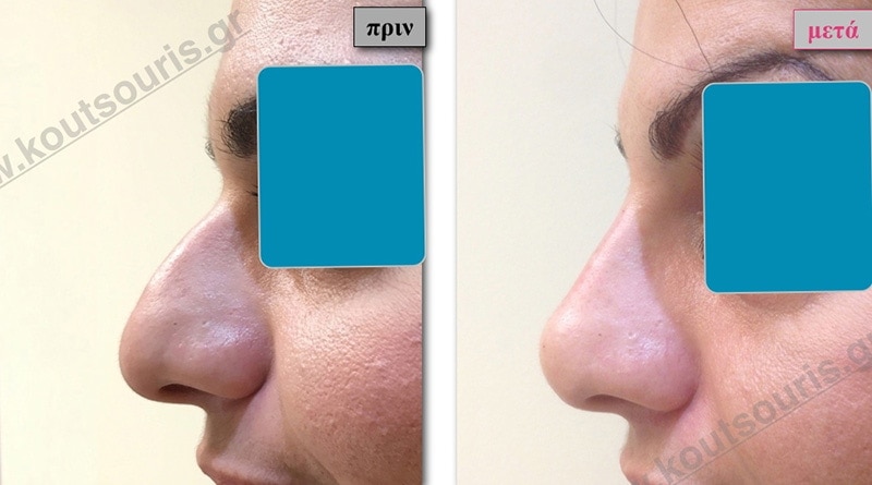 rhinoplasty-with-hyaluronic-acid-31