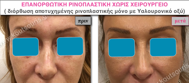 rhinoplasty-with-hyaluronic-acid-32