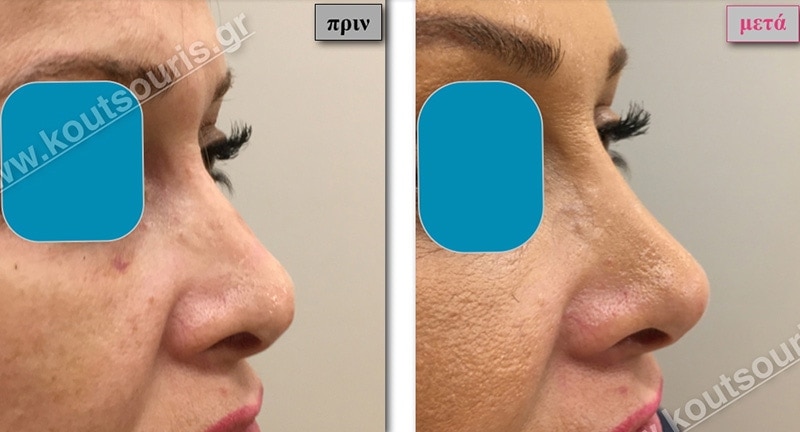 rhinoplasty-with-hyaluronic-acid-33