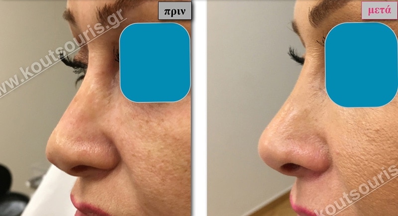 rhinoplasty-with-hyaluronic-acid-34