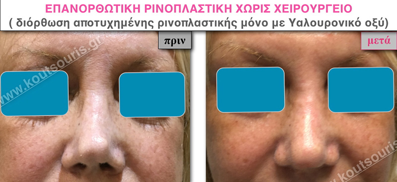 rhinoplasty-with-hyaluronic-acid-35