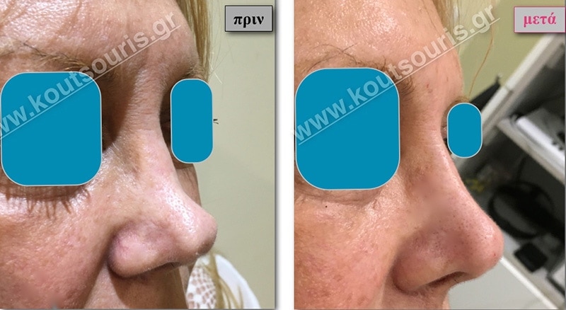 rhinoplasty-with-hyaluronic-acid-36