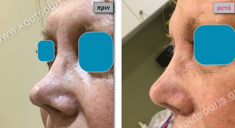 rhinoplasty-with-hyaluronic-acid-37