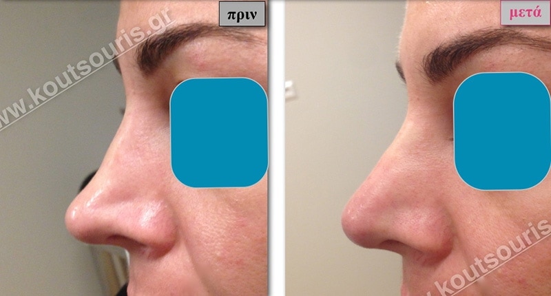 rhinoplasty-with-hyaluronic-acid-39