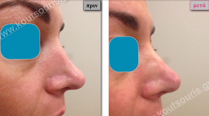 rhinoplasty-with-hyaluronic-acid-40