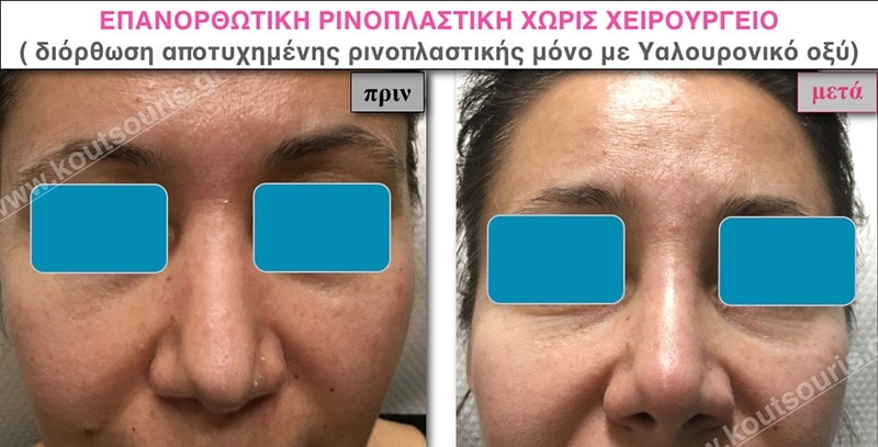 rhinoplasty-with-hyaluronic-acid-41