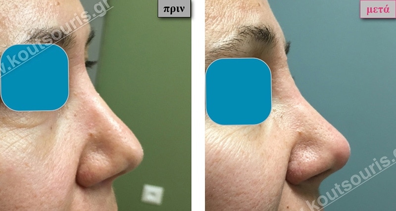 rhinoplasty-with-hyaluronic-acid-42