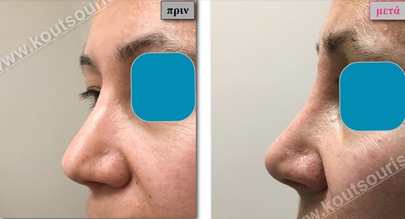 rhinoplasty-with-hyaluronic-acid-43