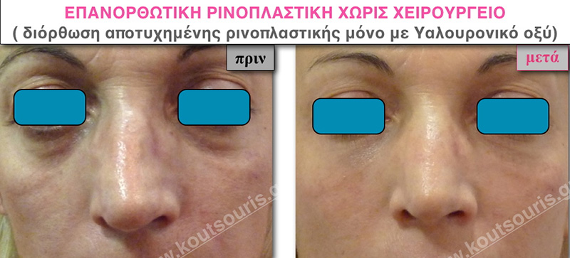 rhinoplasty-with-hyaluronic-acid-44