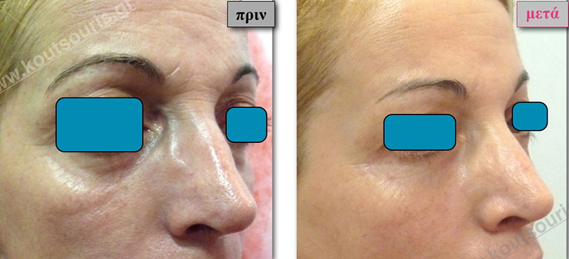 rhinoplasty-with-hyaluronic-acid-45