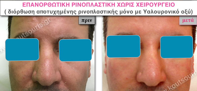 rhinoplasty-with-hyaluronic-acid-46