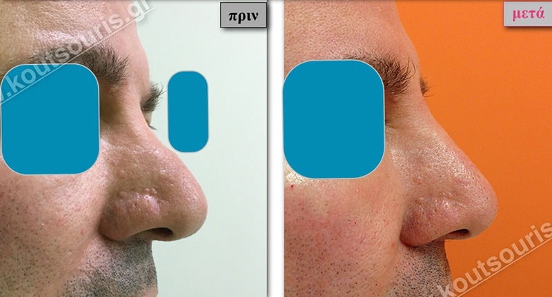 rhinoplasty-with-hyaluronic-acid-47