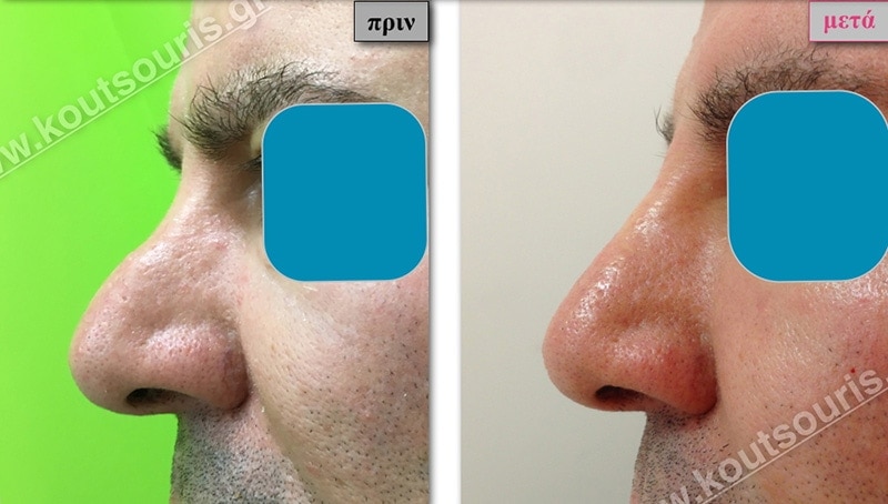 rhinoplasty-with-hyaluronic-acid-48