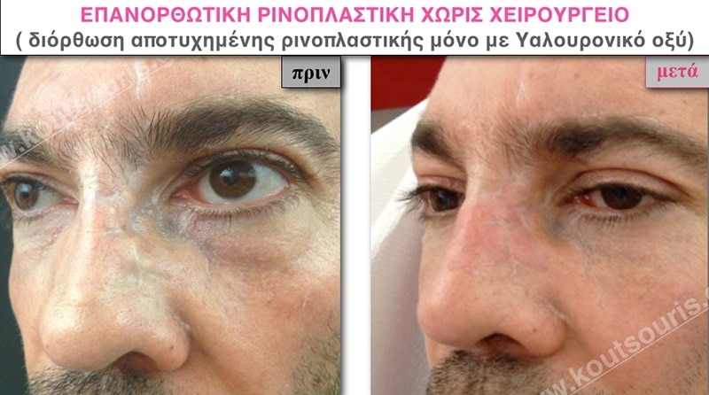 rhinoplasty-with-hyaluronic-acid-49