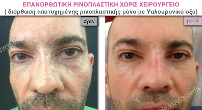 rhinoplasty-with-hyaluronic-acid-50