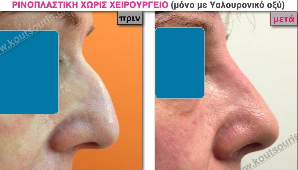 RINOPLASTIKI XORIS XEIROURGEIO.001 RINOPLASTIKI XORIS XEIROURGEIO.001.jpg