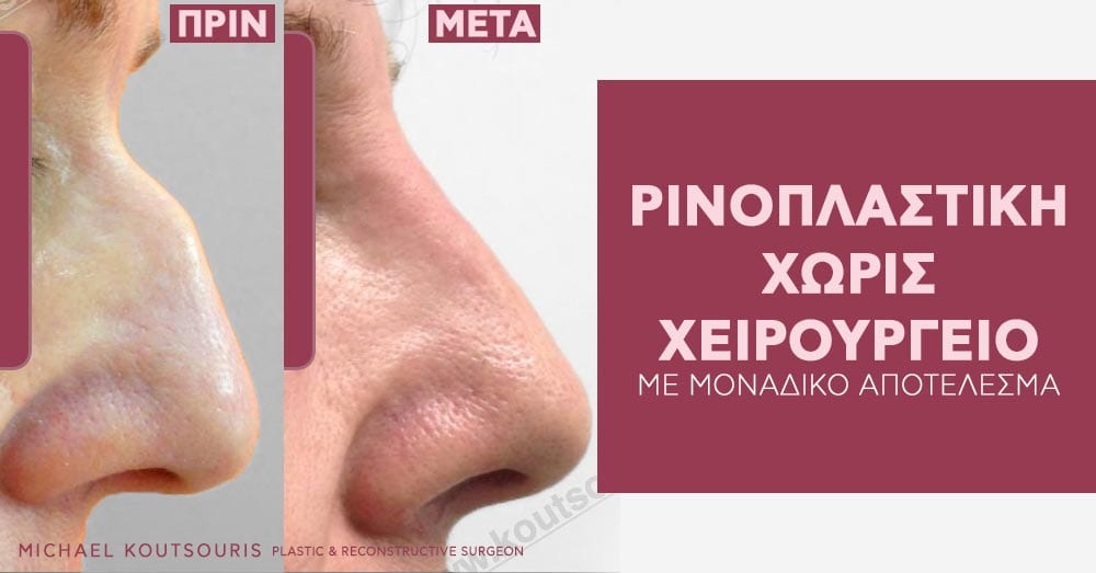 ρινοπλαστική