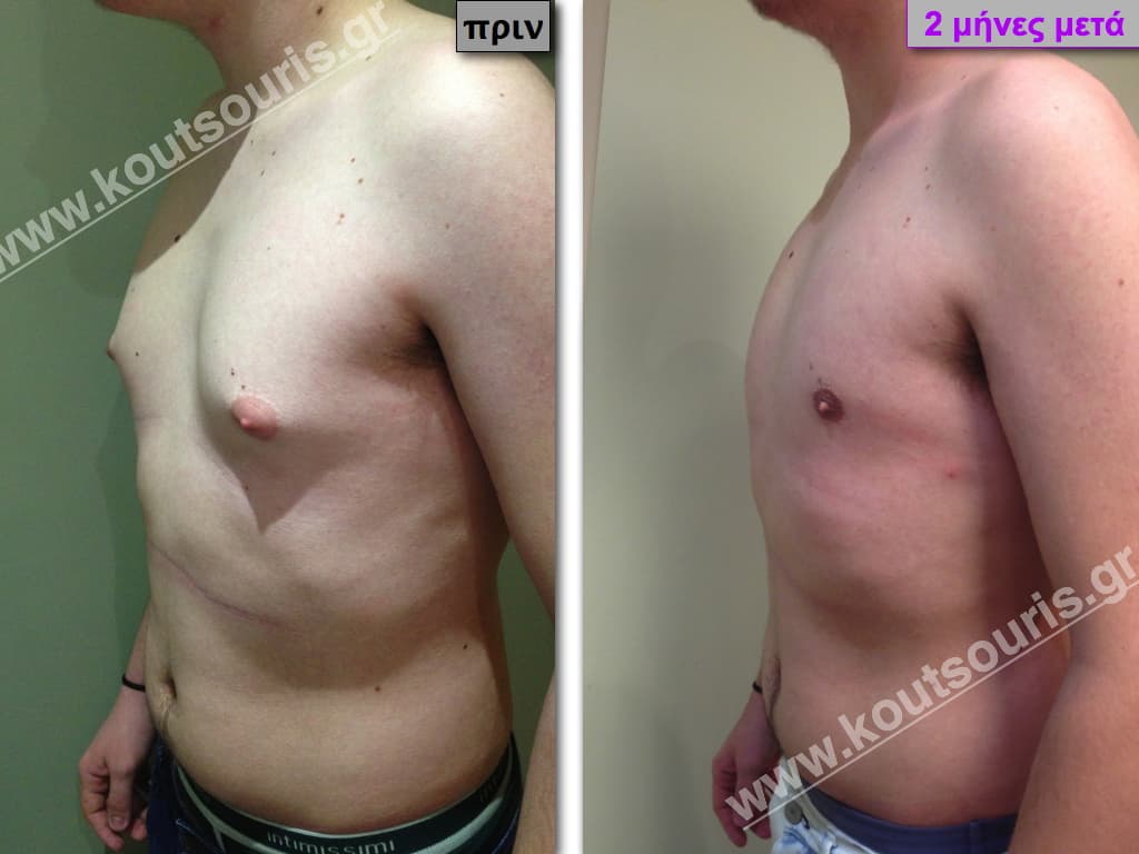 GYNECOMASTIA.015 GYNECOMASTIA.015.jpg