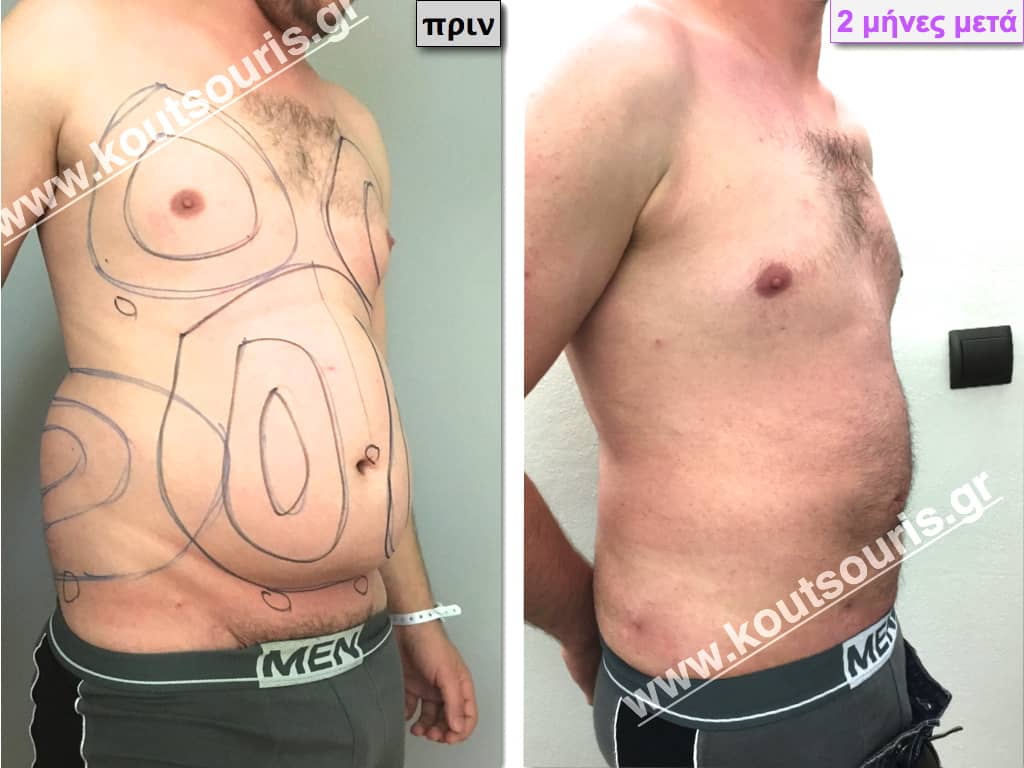GYNECOMASTIA.035 GYNECOMASTIA.035.jpg