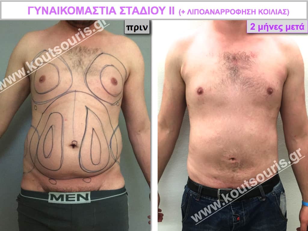 GYNECOMASTIA.038 GYNECOMASTIA.038.jpg
