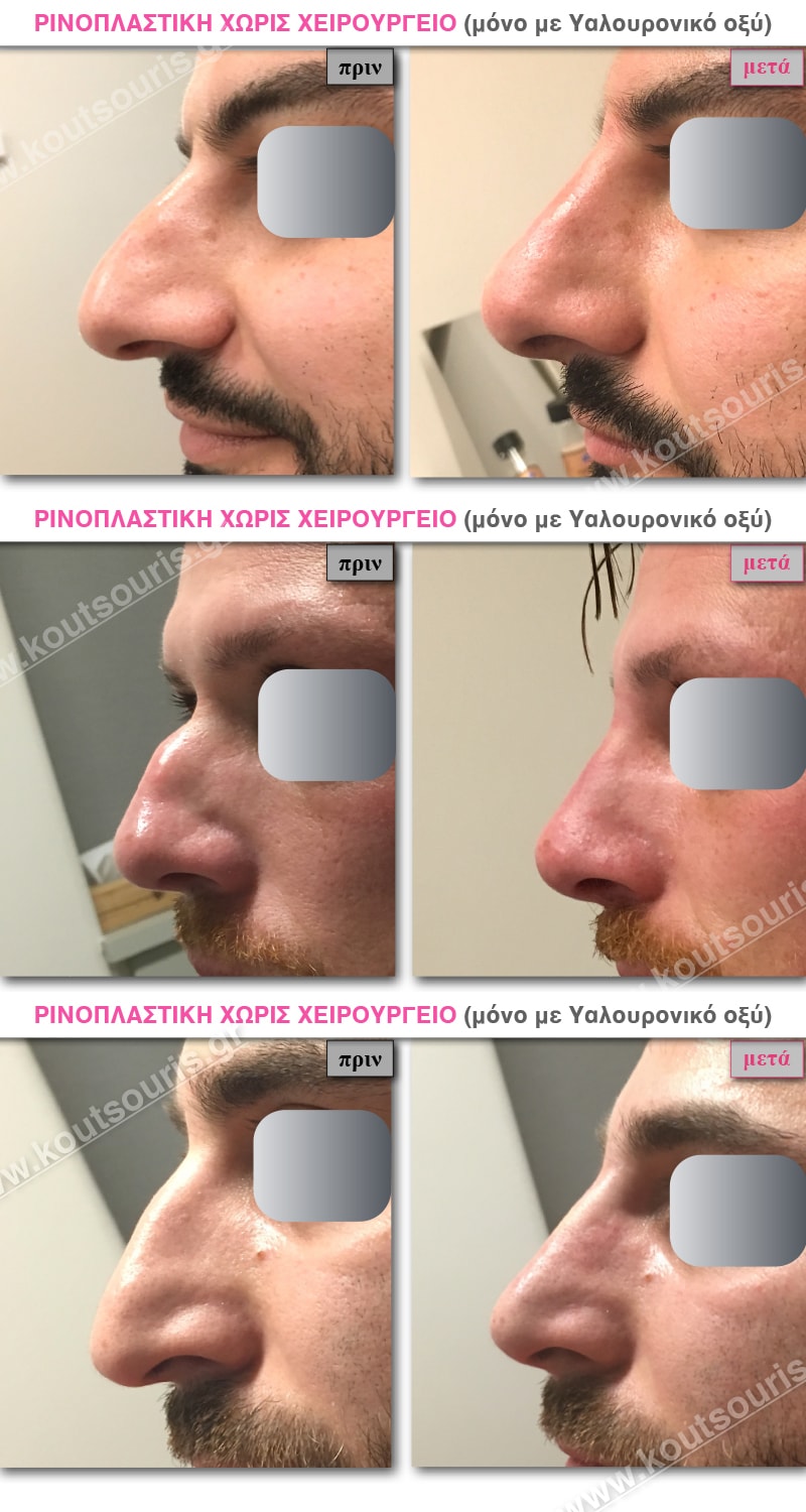 rinoplastiki xoris xeirourgeio