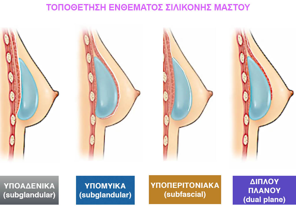 Σκίτσο με την τοποθέτηση ενθέματος σιλικόνης μαστού.