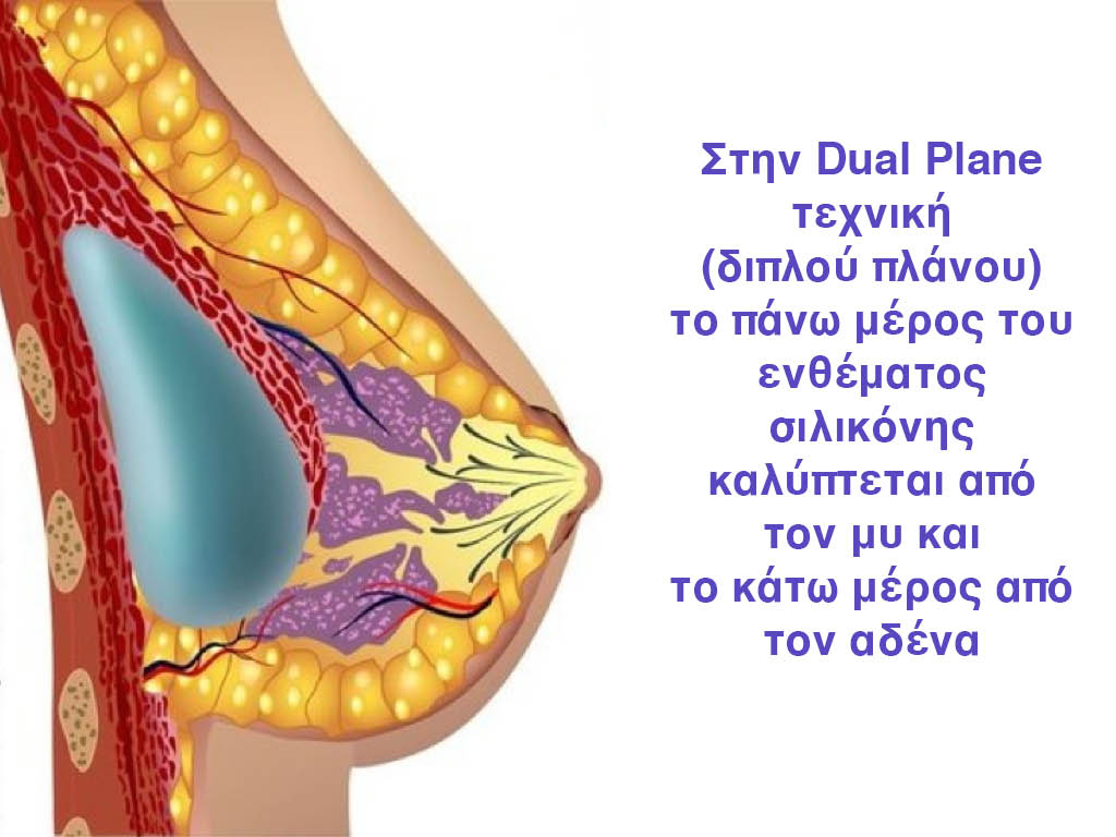 Τεχνική Dual Plane